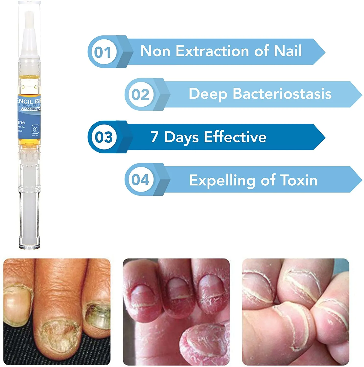 Wholesale Arishine Toenail Fungus, Fungus Stop Solution, 2Pack Pencil Bright
